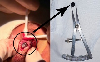 Viên bi sắt 6 mm nằm trong mí mắt nam sinh 15 tuổi suốt nhiều ngày