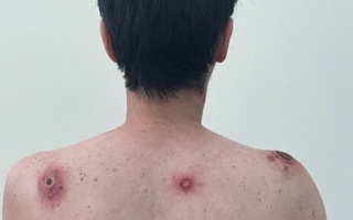 Vết loét tự lành – Dấu hiệu ban đầu của căn bệnh tình dục chết người