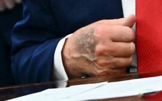 Nhà Trắng lên tiếng về vết bầm tím lớn trên tay Tổng thống Donald Trump