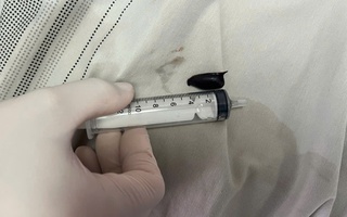 Tìm ra "thủ phạm" gây khốn khổ cho 1 bệnh nhân suốt 2 năm