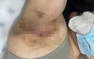 Một phụ nữ thoát được căn bệnh "nhạy cảm" suốt 9 năm