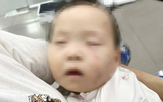 Tạm giữ nữ giáo viên trong vụ bé gái có nhiều vết bầm tím chi chít trên mặt