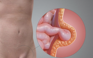 Bé gái quấy khóc vì khối phồng bẹn: Cảnh báo bố mẹ đừng chủ quan