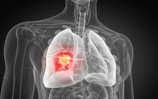 Phát hiện nguyên nhân gây ung thư phổi chưa từng biết