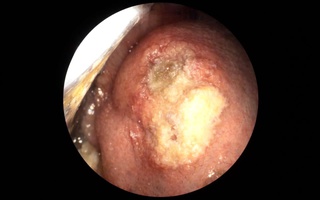 Vết loét nhỏ tưởng vô hại, hóa ung thư lưỡi