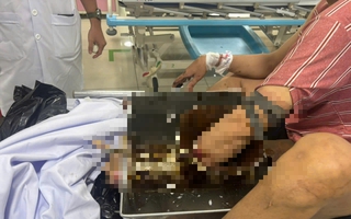 Người đàn ông vác cả máy xay thịt đến bệnh viện cấp cứu