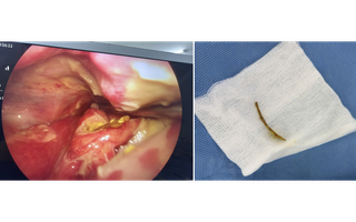 Ngậm viên sủi C để chữa hóc xương cá, người phụ nữ nguy kịch