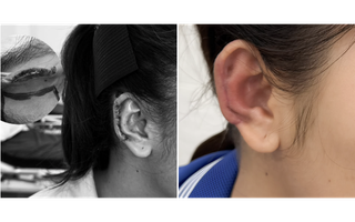 Tái tạo vành tai, trả lại dung mạo cho người phụ nữ trẻ bị tai nạn giao thông
