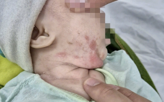 Bệnh lây qua đường tình dục gia tăng, trẻ sơ sinh cũng mắc