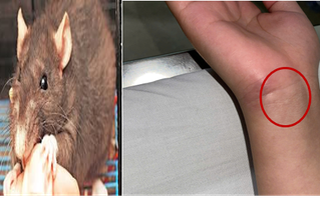 Nam sinh mắc bệnh nguy hiểm từ vết chuột cắn