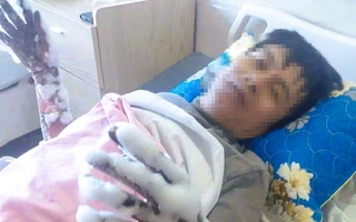 Thanh Hóa thông tin vụ nam công nhân bị điện phóng bỏng nặng 2 tay