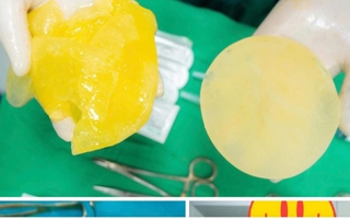 Phụ nữ đã "trùng tu" vòng 1 có nên chơi pickleball?