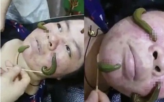 Ớn lạnh dùng đỉa hút mụn, bác sĩ cảnh báo hiểm họa 