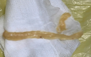 Sán dây gần 1 m “ngọ nguậy” trong đại tràng thanh niên mê đồ tái