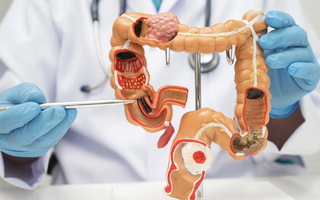 Đau bụng kéo dài, cụ bà 72 tuổi nhập viện trong tình trạng viêm phúc mạc toàn thể