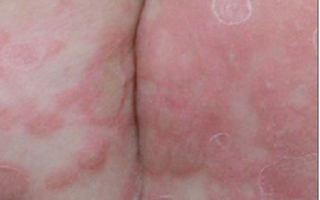 Bé trai 3 tuổi bị giang mai bẩm sinh dù không có triệu chứng