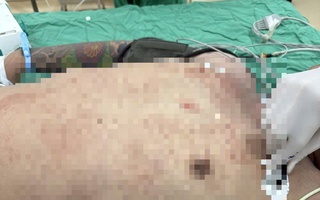 Cứu sống 1 nam bệnh nhân nguy kịch do thủng tim