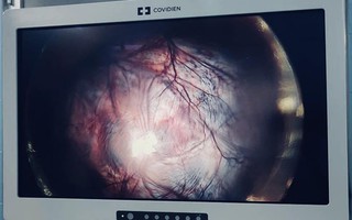 Giữ lại thiên chức làm mẹ cho bệnh nhân 22 tuổi