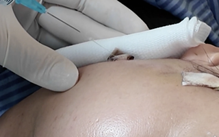 Căng chỉ da mặt tại spa, người phụ nữ gặp biến chứng nặng