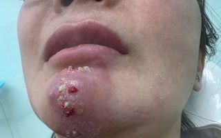 Tin quảng cáo “bật tông nhanh”, nhiều người biến dạng mặt vì làm đẹp cận Tết