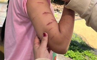 Sở Y tế tỉnh Cà Mau thông tin về vụ nữ sinh bị chị họ gây thương tích