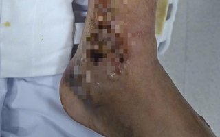 Đắp thuốc, một người đàn ông suýt mất chân