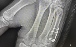 Nam sinh gãy xương bàn tay sau cú đấm boxing