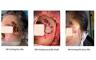 Ghép da thành công cho cô gái bị hoại tử vùng mặt sau tai nạn giao thông