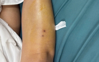 Tây Ninh: Phun thuốc cỏ, người phụ nữ bị rắn cắn nguy kịch