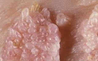 Người đàn ông gần 70 tuổi mắc sùi mào gà sau quan hệ không an toàn