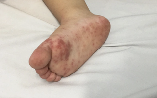 Dịch tay chân miệng “nóng” trở lại, trẻ nhỏ đối mặt nguy cơ biến chứng nặng