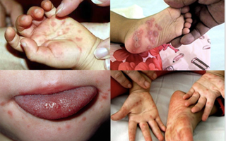 Sốt xuất huyết tăng 2,2 lần, tay chân miệng gấp 5 lần