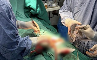 Người đàn ông nhập viện sau khi tự cắt bộ phận sinh dục