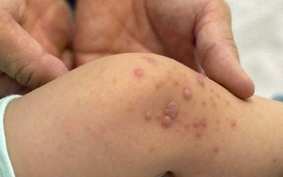 Bệnh tay chân miệng tăng nhanh, bác sĩ cảnh báo nóng