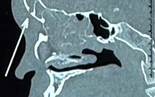 Tưởng chỉ viêm xoang đơn giản, nam thanh niên suýt mất mạng vì bị biến chứng