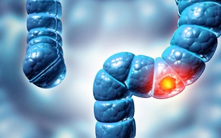 Phát hiện virus mới liên quan loại bệnh ung thư phổ biến