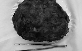 Cô gái trẻ về nước mổ u vú 17 cm, giữ được “vòng một”