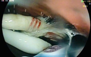 Người đàn ông nuốt cùng lúc 3 bàn chải đánh răng vào bụng