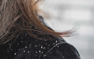 Chuyên gia cảnh báo: 50% dân số từng bị gàu nhưng điều trị chưa đúng