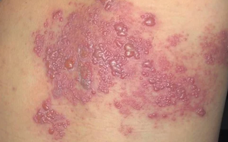 Zona có thể khiến 1/3 người trưởng thành mắc trong đời