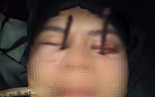 Cứu nam thanh niên bị 2 chiếc đũa đâm sâu vào 2 hốc mắt