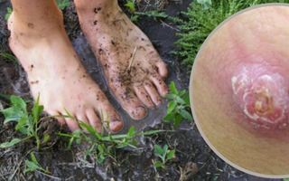 Hiểu đúng về bệnh do "vi khuẩn ăn thịt người"