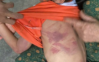 Bé gái lớp 2 bị bạn cùng lớp dùng thước đánh thâm tím người vì không cho kẹo