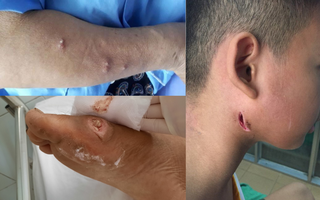 Bộ Y tế nói gì về bệnh "sốt đất" (Whitmore) sau 23 ca tử vong ở Thái Lan?