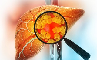 Đảo ngược gan nhiễm mỡ không cần ăn kiêng: Đột phá từ Mỹ