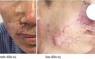 Ung thư da tái phát sau nhiều lần mổ, lan ngầm dưới da