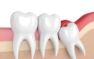 Nhổ răng khôn có được BHYT chi trả?