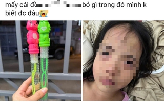 Bé gái 5 tuổi tổn thương mắt sau khi thổi bong bóng xà phòng