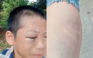 Xôn xao clip bé trai mắt bầm tím, khóc kêu cứu vì nhiều lần bị đánh đập khi ở cùng bố và vợ mới