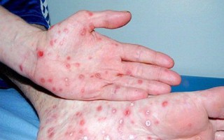 TPHCM: Số người mắc bệnh giang mai tăng đột biến